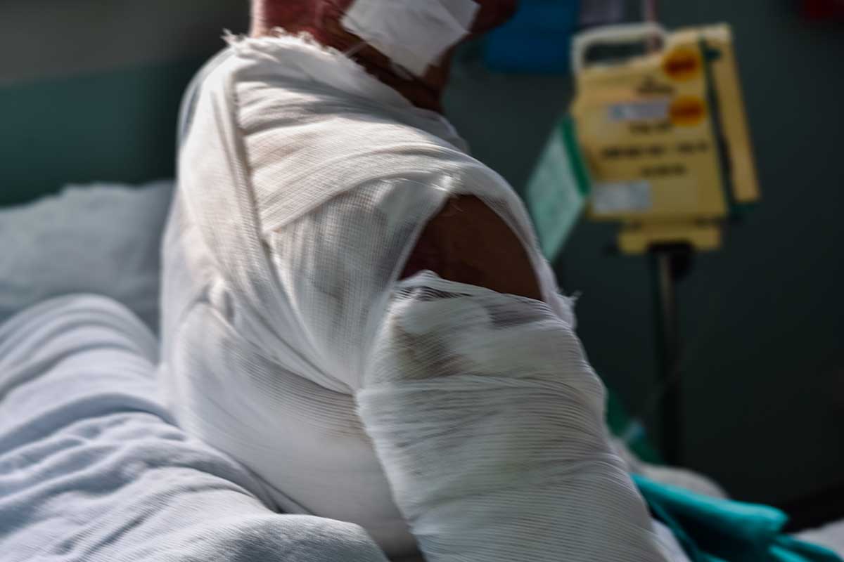 burn injury